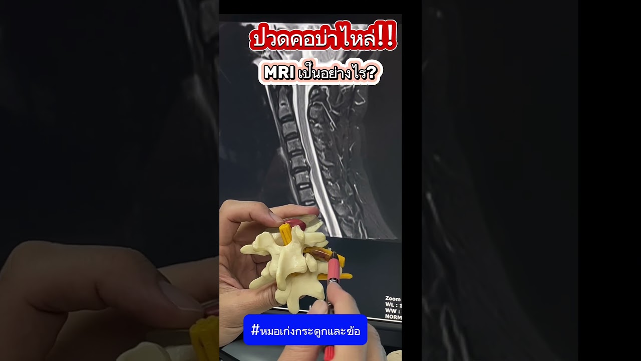 ปวดคอบ่าไหล่ MRI เป็นอย่างไร? #หมอเก่งกระดูกและข้อ #ปวดคอ #ปวดคอบ่าไหล่ #MRI