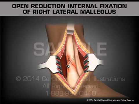 Открытая репозиция и накостный остеосинтез правой наружной лодыжки пластиной с угловой стабильностью