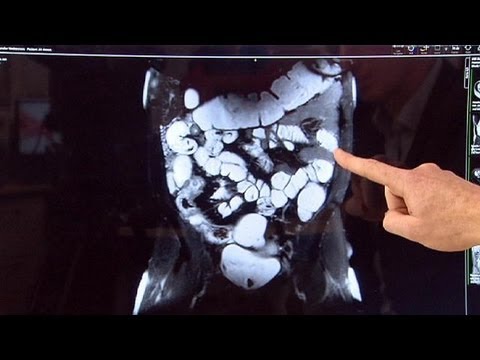 Videó: A Crohn-betegség Mellékhatásai: Vérszegénység, Szájfekélyek és Egyebek