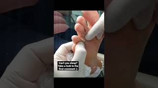 Removing a Tunga Penetrans Blackhead from a patients foot ? satisfying