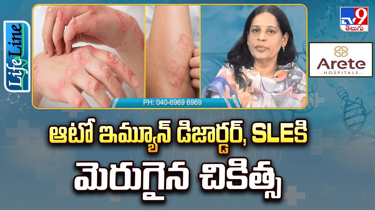 Life Line : ఆటో ఇమ్యూన్ డిజార్డర్, SLE కి మెరుగైన చికిత్స - TV9