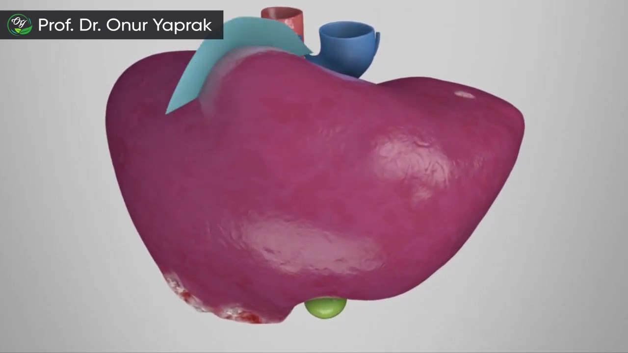 Karaciğer Kanser Ameliyatı | Prof. Dr. Onur Yaprak