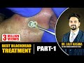 Best blackhead treatment part 1 comedone extraction nose