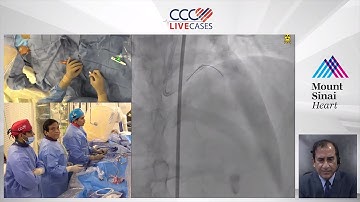 FFR & OCT Guided Staged PCI of LAD Diagonal Bifurcation (Aug 20th)