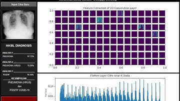 Pneumonia and Covid-19 Detection System based on Deep Learning