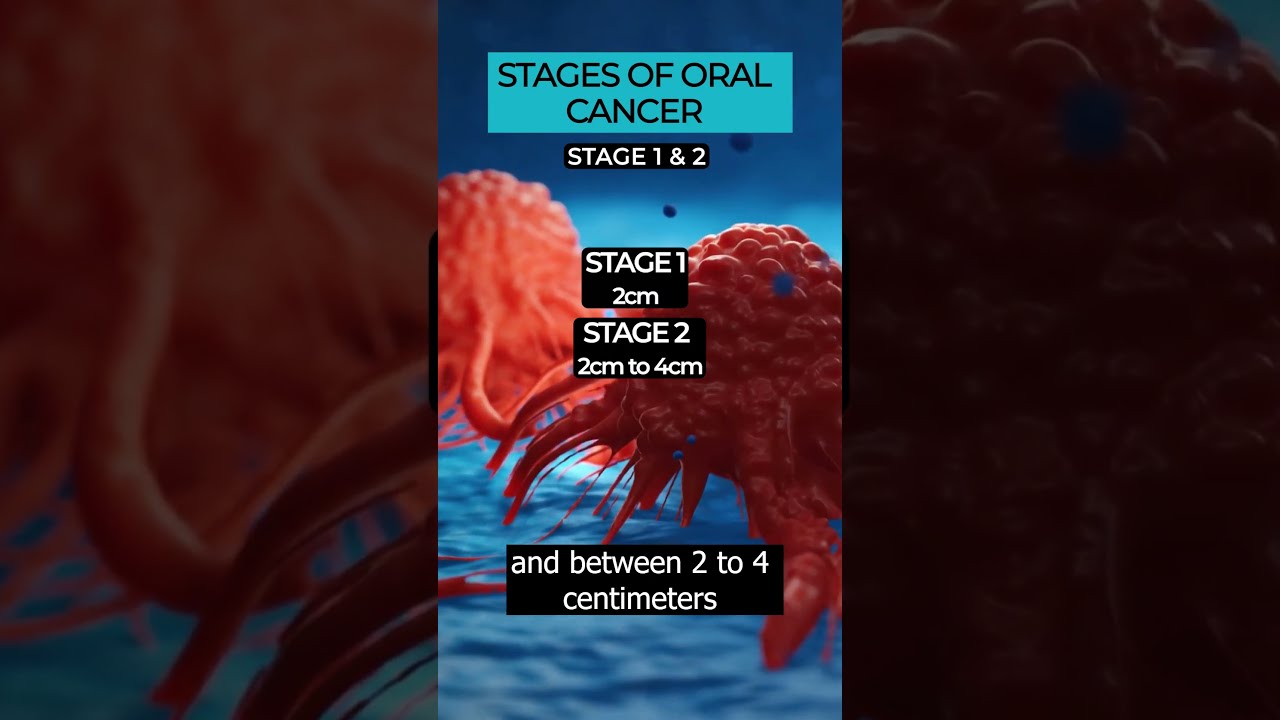 Understanding The Stages Of Oral Cancer Diagnosis And Treatment OralCancer Cancerstages