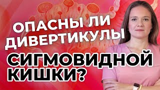 Опасны ли дивертикулы сигмовидной кишки?