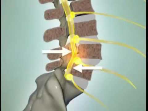 Video: Cilmes šūnu Terapija Muguras Smadzenēm