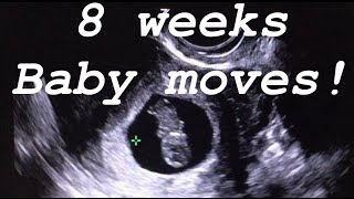 8 weeks ultrasound. Baby moves.