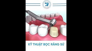Kỹ thuật bọc răng sứ được thực hiện thế nào? Mô phỏng kỹ thuật bọc sứ