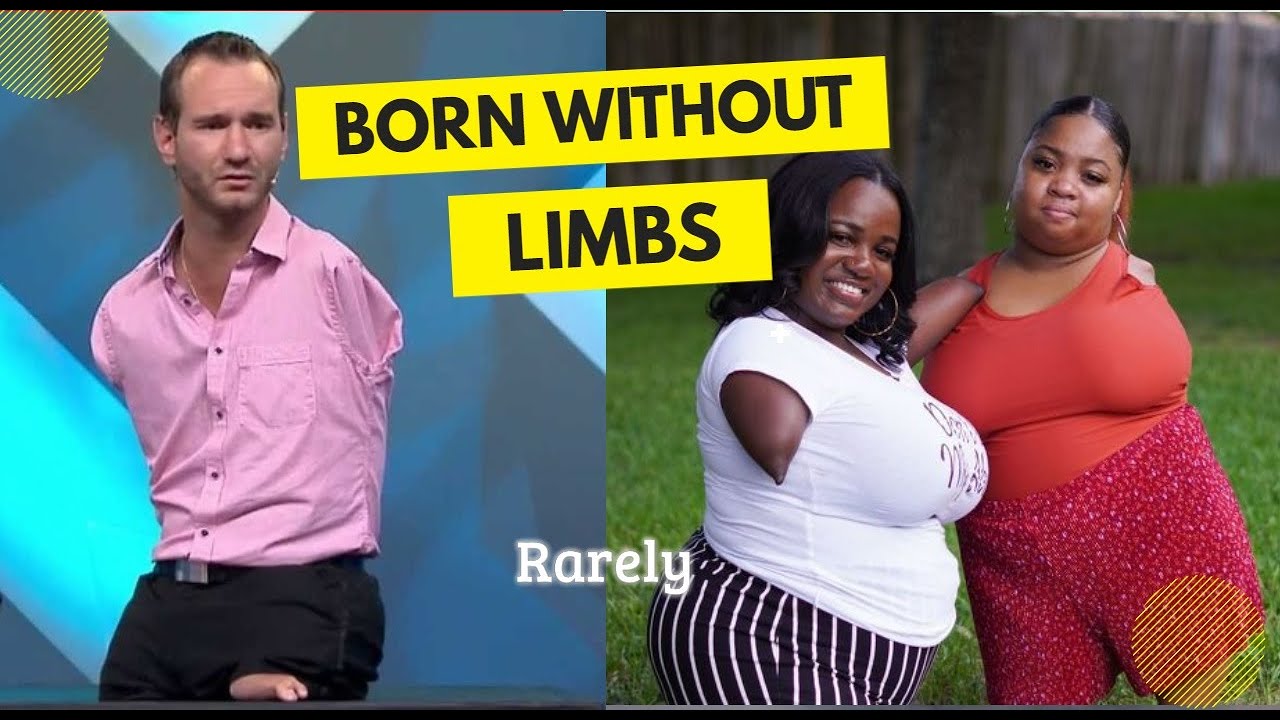 15 AMAZING Individual Born & Living without Limbs | Born Different ...