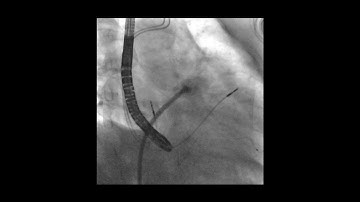 Left atrial appendage closure deployment for managing thromboembolic risk in atrial fibrillation