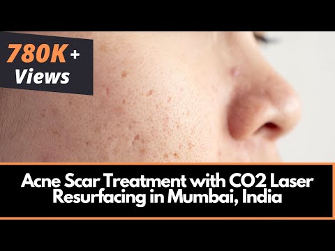 Acne Scar Treatment with CO Laser Resurfacing in Mumbai, India | Dr. Rinky Kapoor