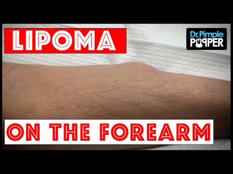 A Single, Noticeable Lipoma On Forearm