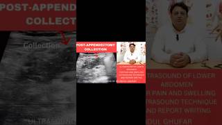 #ultrasound #appendicitis #appendixcarry #video #abdomen #radiology #fyp #viral #youtubeshorts #fup