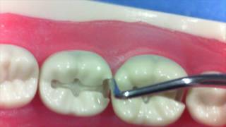 99 Second Tips  Class II Composite to Amalgam Prep Conversion