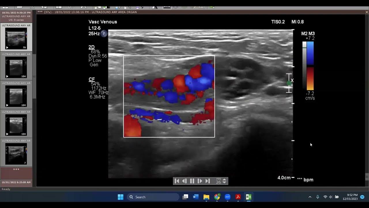 Nice illustrative ultrasound case of inguinal hernia in female Vs Round