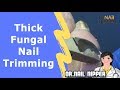 Are those Thick Fungal Toenail Trimming? Does that mean Fungus Toenails?