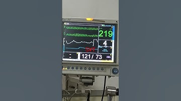 ventricular tachycardia in cardiac monitor