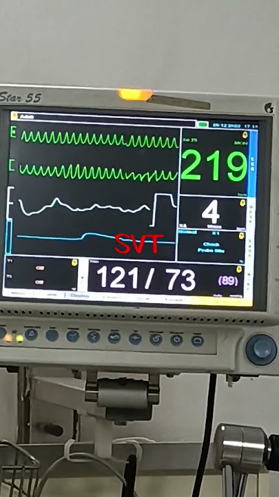 ventricular tachycardia in cardiac monitor
