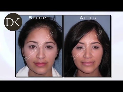 Video thumbnail: Revision Rhinoplasty