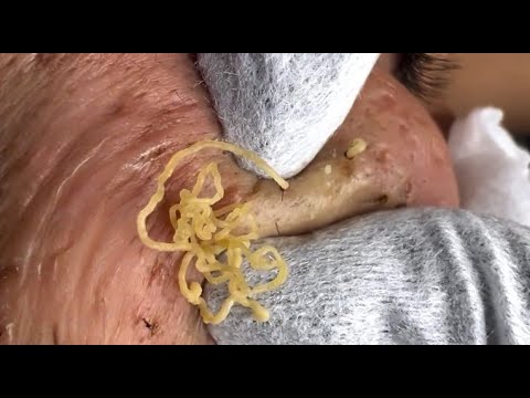 Blackhead Removal: Satisfying  Routine | 122