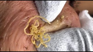 Blackhead Removal Satisfying Routine 122