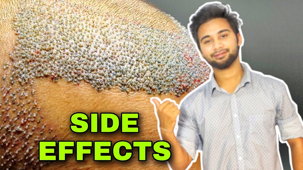 4 Latest Side Effects Of Hair Transplant Is Hair