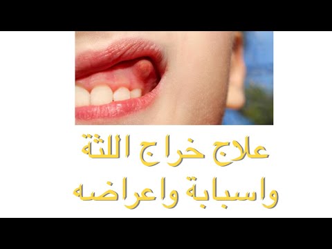 كيفية علاج خراج اللثة والأسنان في أسرع وقت وأسبابه وأعراض خراج النيرة