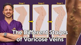 The Different Stages of Varicose Veins