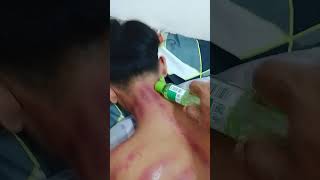 Kerokan Leher Remaja 30