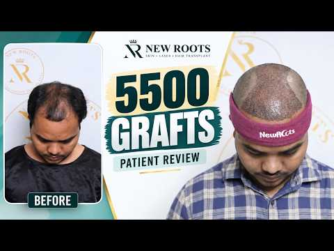 From Hair Fall to Hair Restoration! 🔥 | 5500 Grafts | Patient Review | Hair Transplant in Lucknow