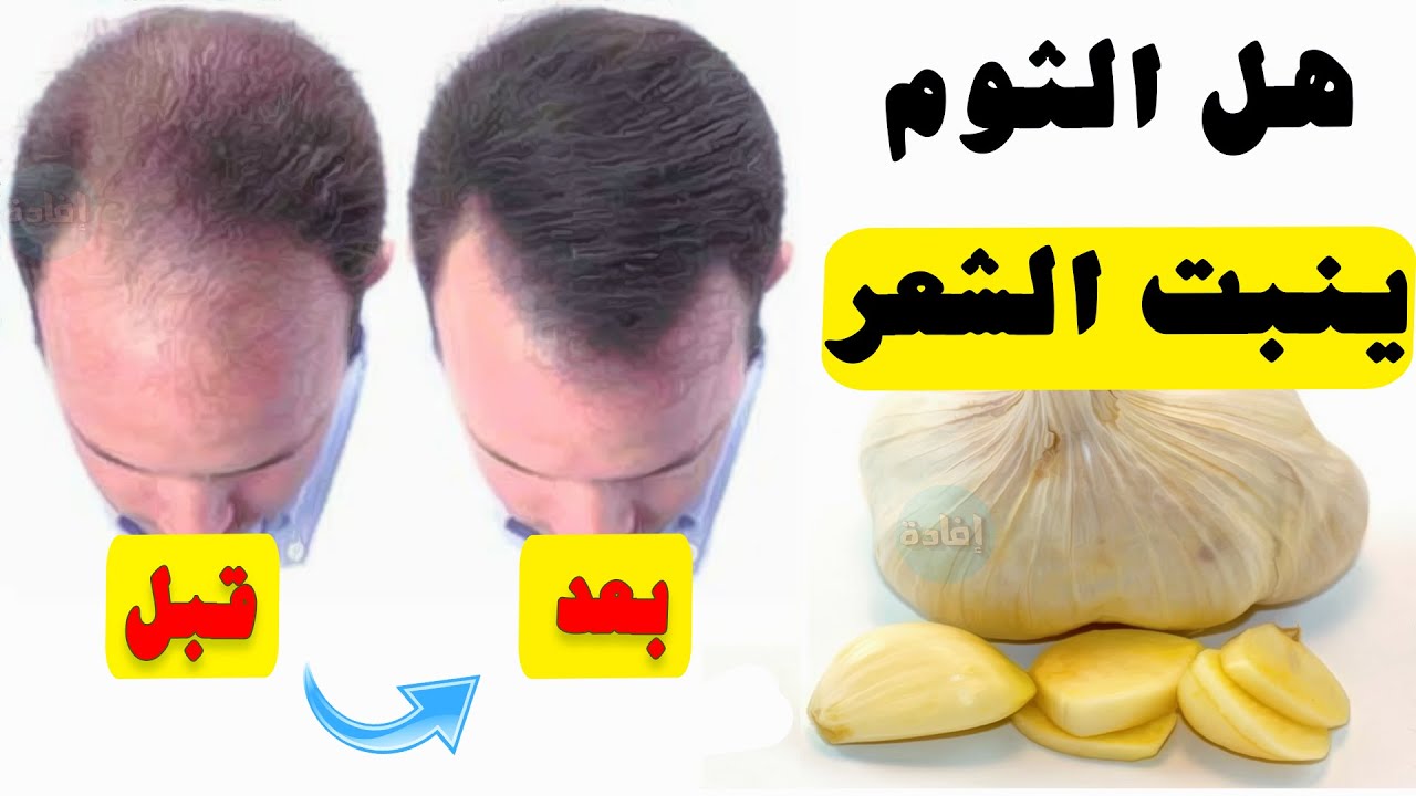 هل الثوم ينبت الشعر