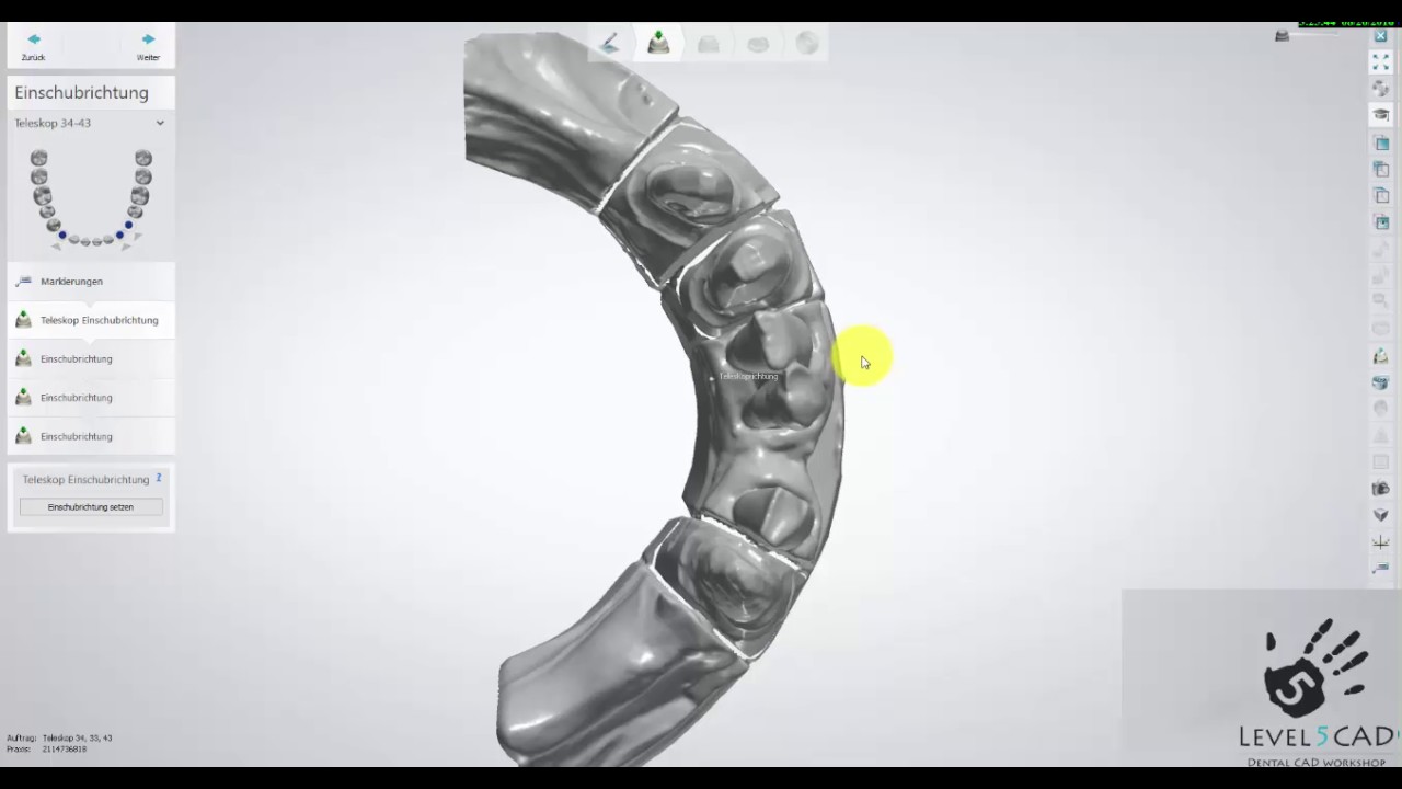 Teaser Videotutorial 3Shape Dental System™ 2016: Die Konstruktion von