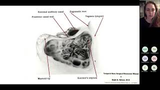 The Petrosal Approach - Dr Kristen Angster