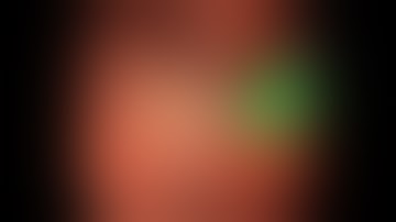 ERCP for acute Severe cholangitis