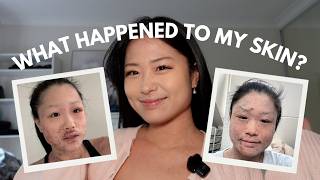 Topical Steroid Withdrawal: My Story & The Truth Behind TSW