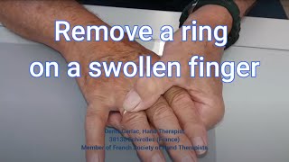 REMOVE A RING ON SWOLLEN FINGER