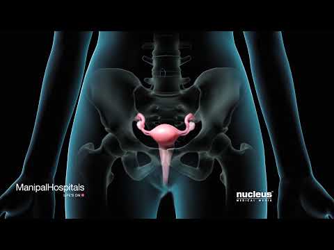 Video: Fibromyom Prsu, Nodulární Fibroid
