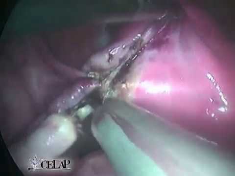 HISTERECTOMIA Vaginal Asistida por Laparoscopía camera iphone 8 plus apk