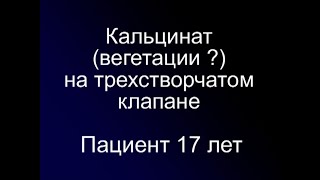 Кальцинированные Вегетации? На Трехстворчатом Клапане