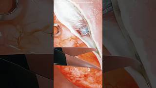 Tonsillectomy Procedure (3D Animation)#tonsillectomy #tonsillitis #tonsillectomyrecovery