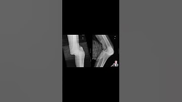 Knee Dislocation #meded #doctor #emergencymedicine  #medicalschool #orthopedicsurgeon #trauma