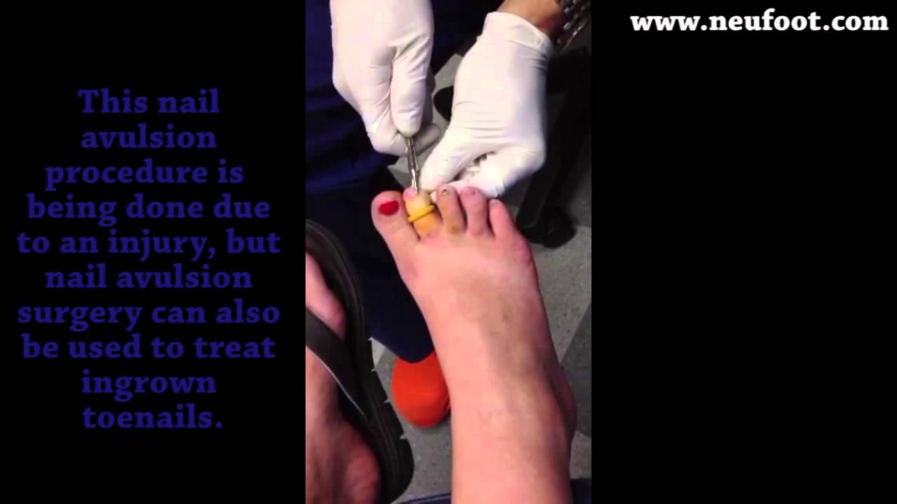 Ingrown Toenail Treatment: The Sunset Foot Clinic: Podiatry