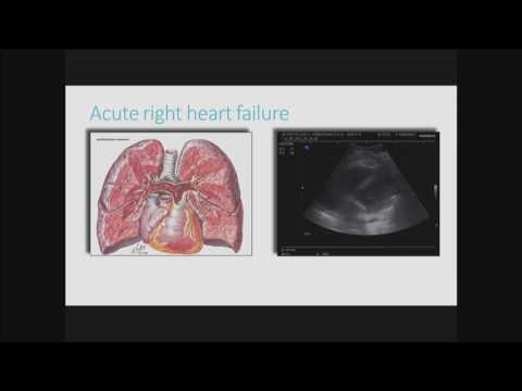 E. Boero - Does this patient have pulmonary embolism?
