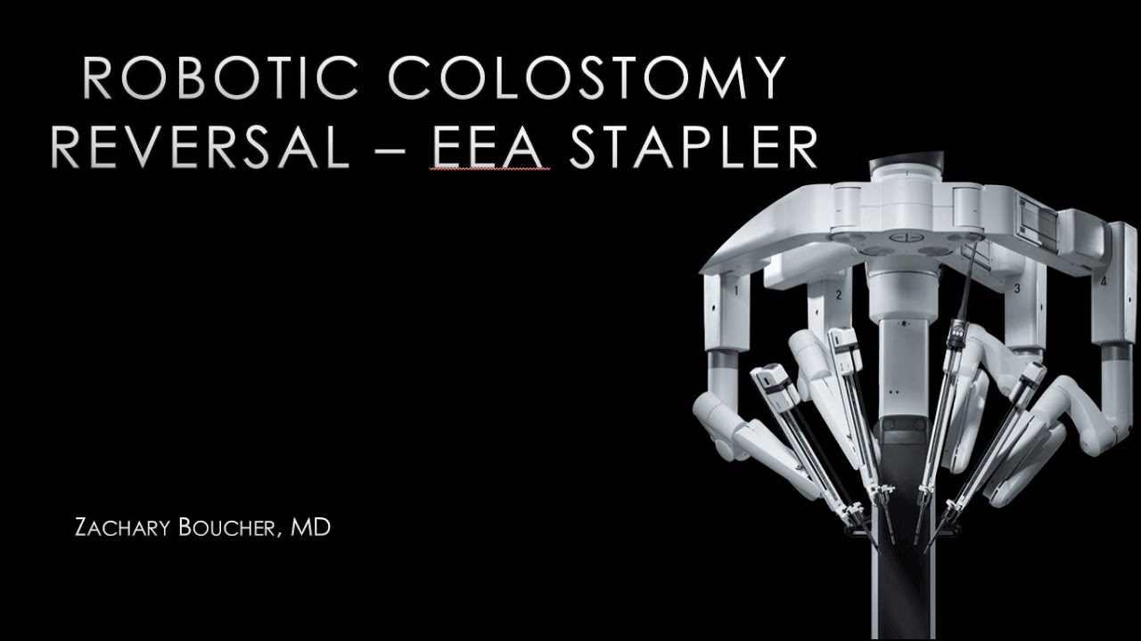 Robotic Colostomy Reversal with EEA Stapler YouTube