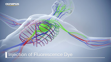 VEII ICG/IR – How Does It Work?