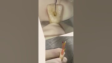 Complete RCT Procedure from beginning to the end