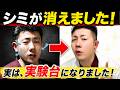 【僕がシミを消した方法！】実際にシミが消えた方法です！