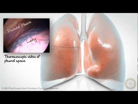 Video: Vedelik Rinnus (pleura Efusioon)